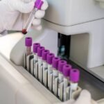 FDA greenlights marketing of first Alzheimer’s blood test for some patients