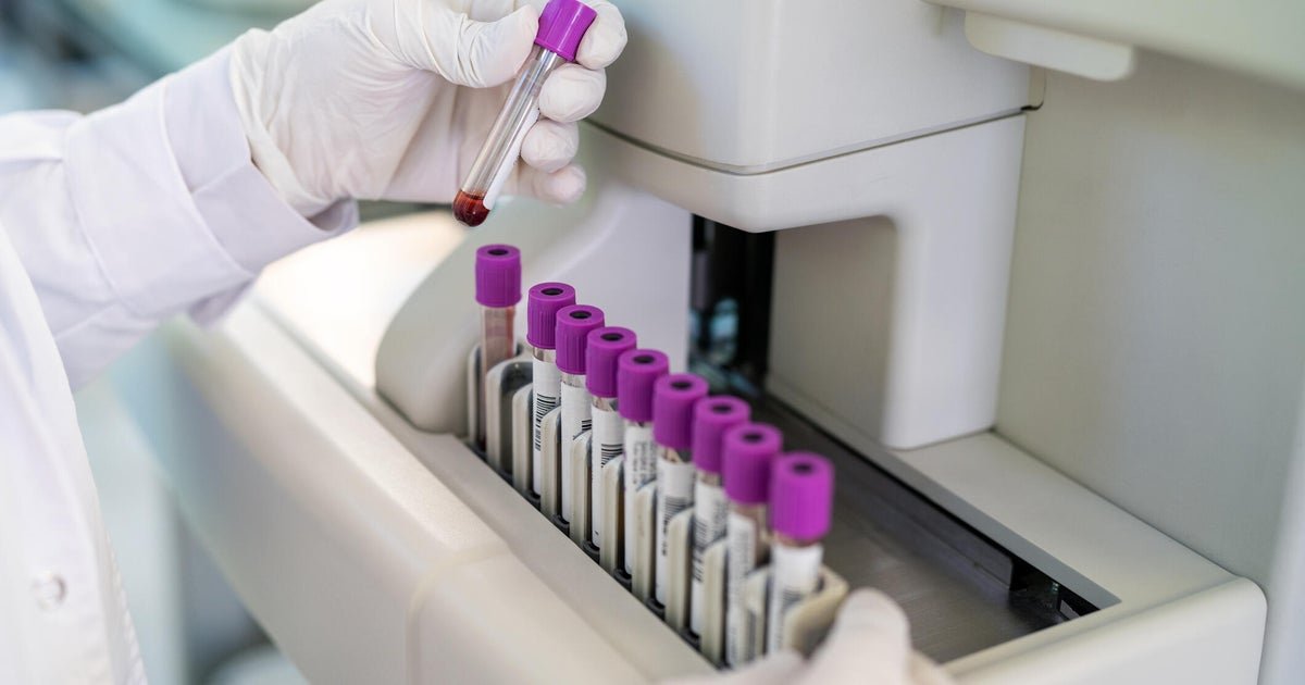 FDA greenlights marketing of first Alzheimer’s blood test for some patients