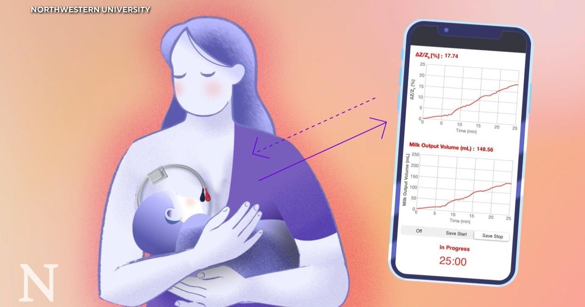 New breastfeeding device could ease anxiety for moms and improve NICU care